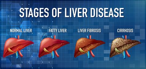 Liver Cancer Types And Stages