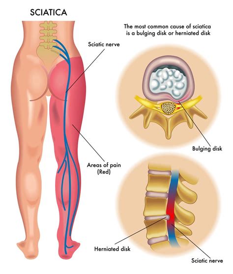 What causes sciatica and which treatments can stop the pain