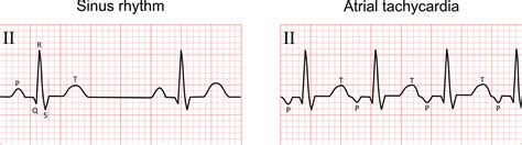 Paroxysmal Atrial Tachycardia Vs Sinus Tachycardia