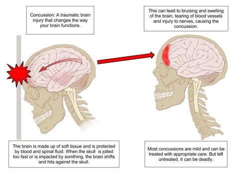 Head Injury: Symptoms, Causes, and Treatment