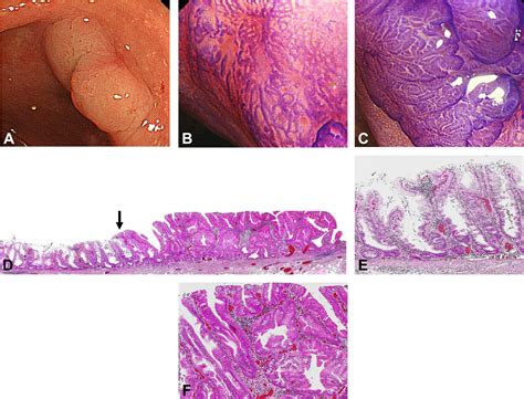 Distinct endoscopic characteristics of sessile serrated adenoma/polyp ...