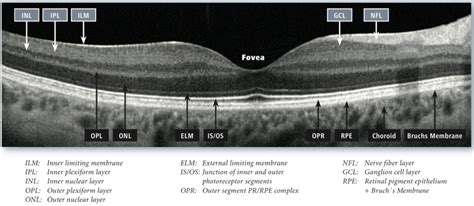 How to read OCTs: 8 fundamental diseases - EyeGuru