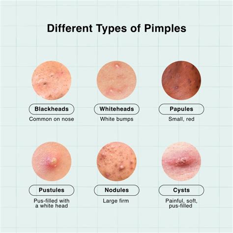 Pimples on forehead: What are the Causes & Treatments?