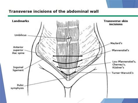 Abdominal incision and abdominal anatomy