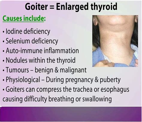 Pin by ♡ JVG ♡ on THYROID | Enlarged thyroid, Thyroid, Thyroid causes