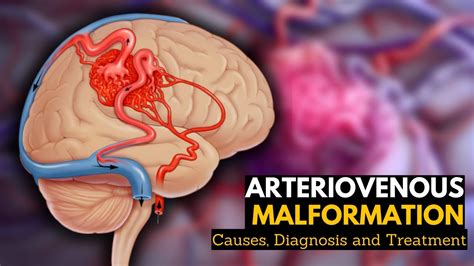 Arteriovenous Malformation, Causes, Signs and Symptoms, Diagnosis and ...