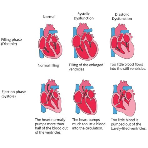 Why is Every 3rd Person in the Population Suffering from a heart attack ...