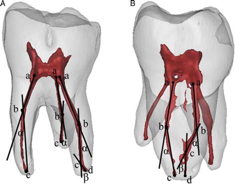 Root Canal Morphology of Permanent Three-rooted Mandibular First Molars ...