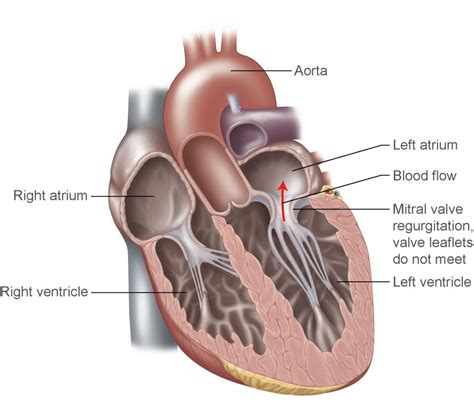 Best Mitral Valve Surgery Treatment in India