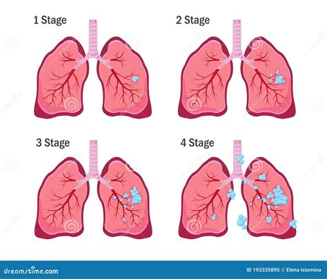 Lung Cancer Staging Diagram