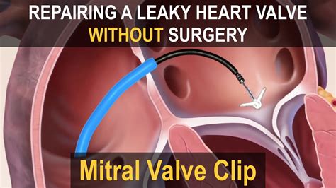 MitraClip (Mitral Valve Clip) - Repairing a Leaky Heart Valve without ...