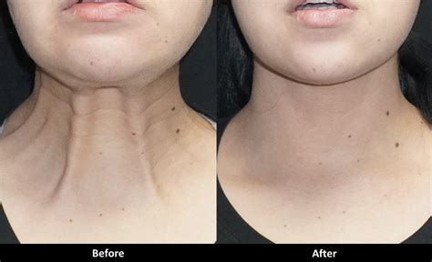 Botox can treat wrinkles and bands on the neck