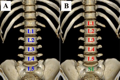 The association between lumbar rib and lumbosacral transitional ...