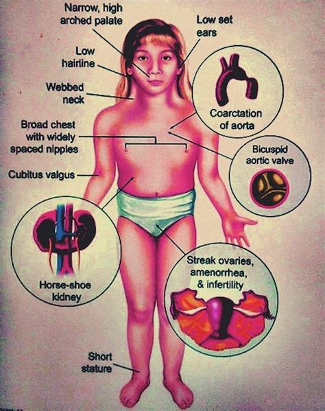 Turner Syndrome Nursing Assessment and Diagnostic Findings, Management ...