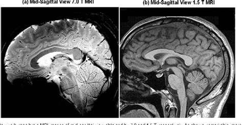 Figure 4 from New brain atlas - Mapping the human brain in vivo with 7. ...