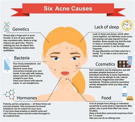 Acne Zones and Causes