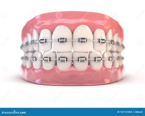 Teeth Fitted With Braces Royalty-Free Stock Photo | CartoonDealer.com ...