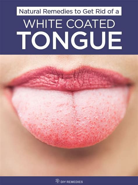 Natural Remedies to Get Rid of a White Coated Tongue It is not a ...