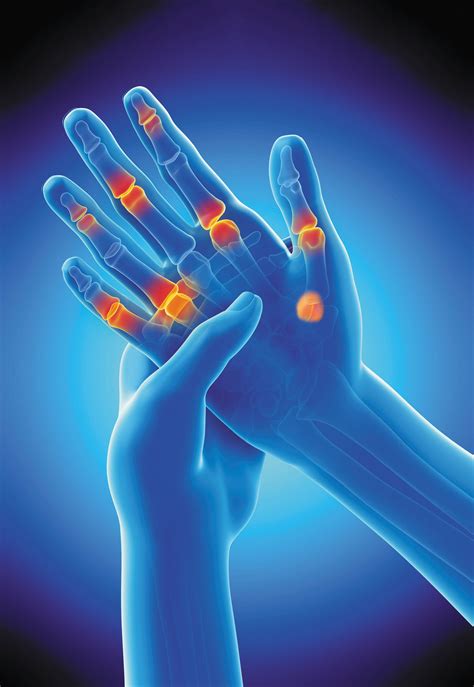 Identifying arthritis in your fingers and thumbs - Harvard Health