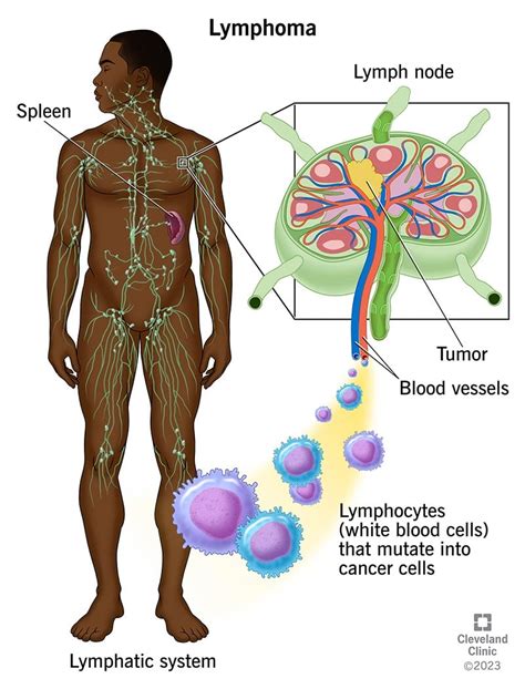 Lymphoma: Symptoms, Causes and Treatment