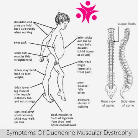 Duchenne Muscular Dystrophy Prevention And Treatment