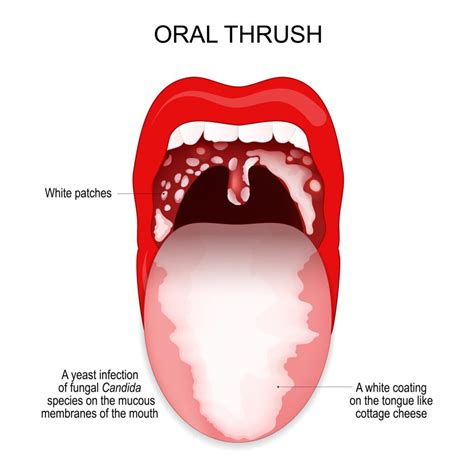 Why Does the Tip of My Tongue Hurt? 6 Possible Causes