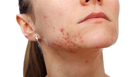 Acne Vulgaris - Symptoms, Causes and Treatment | Dr. Sumit Gupta