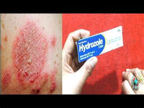 Hydrozole cream 20 grams | Lazada