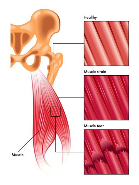 5 Steps to Quickly Recover from a Pulled Back Muscle