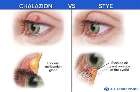 Eyelid Pimple Inside