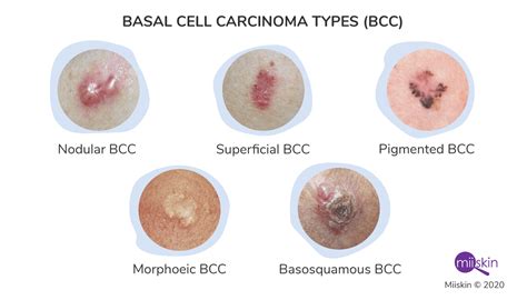 Basal Cell Carcinoma - Symptoms, Types and Pictures