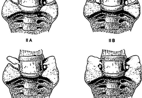 Skull and Spine: Lumbosacral transitional vertebrae