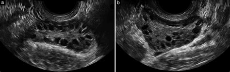 Normal Vs Polycystic Ovaries Ultrasound