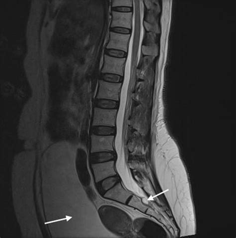 Cauda equina syndrome due to leptomeningeal carcinomatosis: a medical ...