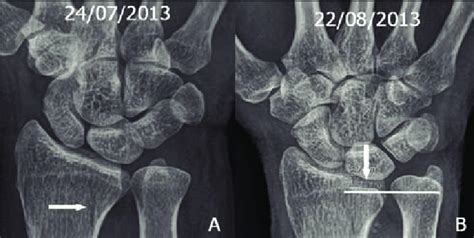 A. Initial non displaced sagittal fracture near the radial notch. B ...