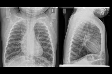 Reducing Unnecessary Chest X-Rays in Infants - Choosing Wisely Canada