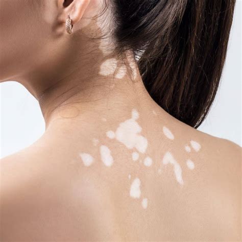 white spots on skin - NOWMI