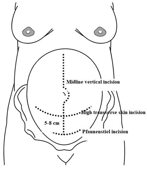 Can high transverse skin incision (Modified Maylard) be a new ...