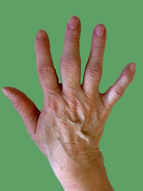 Osteoarthritis in the Hand – Aberdeen Virtual Hand Clinic