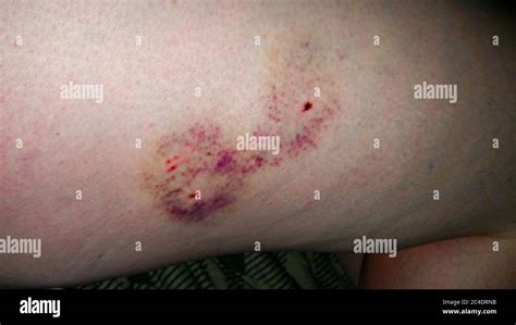 Dog Bite Wound Stock Photo - Alamy