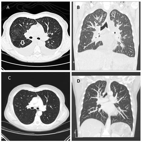 Chest CT scan showing evidence of pulmonary edema (A-B). | Download ...