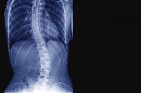 Spinal Deformities - Endospine Hellas