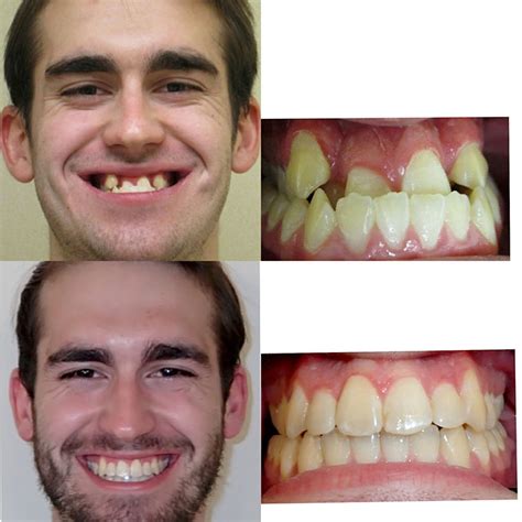 Before & After Braces | Wazio Orthodontics