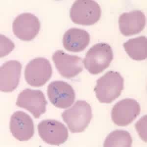 Babesiosis