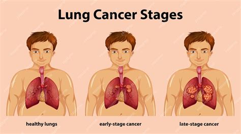 Free Vector | Informative illustration of lung cancer stages