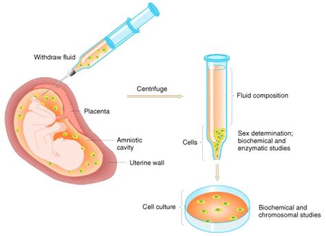 Amniocentesis