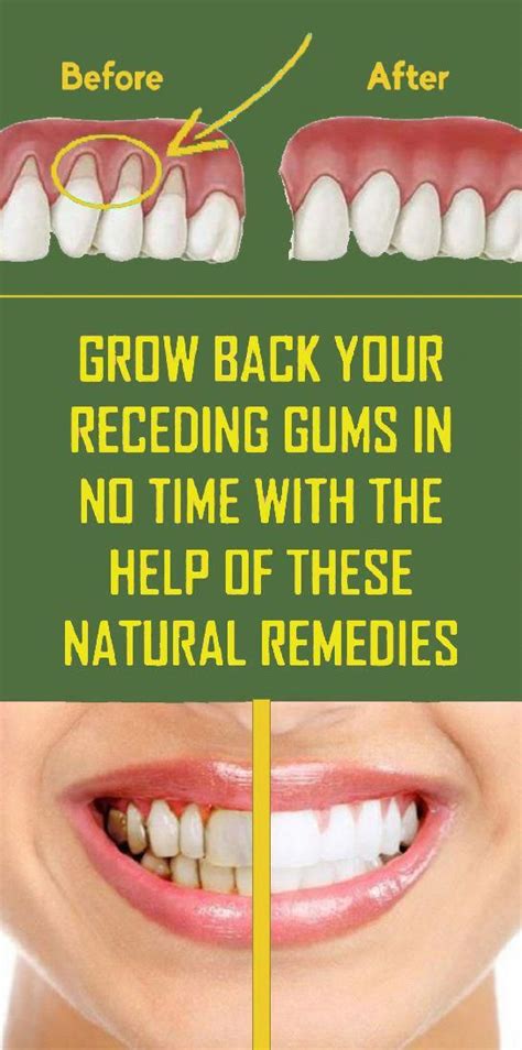 Pin by Cheriti Ridner on Home remedies in 2020 (With images) | Receding ...