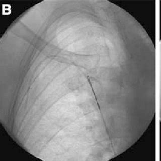 Removal of a fragment of a Port-a-Cath, located in the right subclavian ...