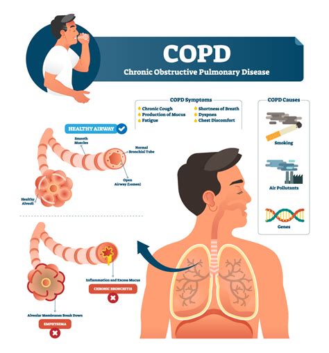 SPIROMETRY IN COPD