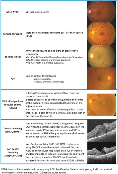 Diabetic macular edema treatment guidelines in India: All In ...